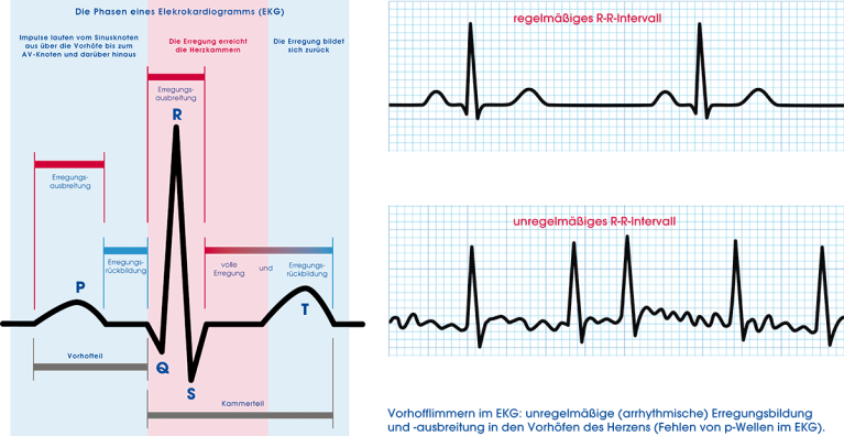 EKG und Vorhoffflimmern