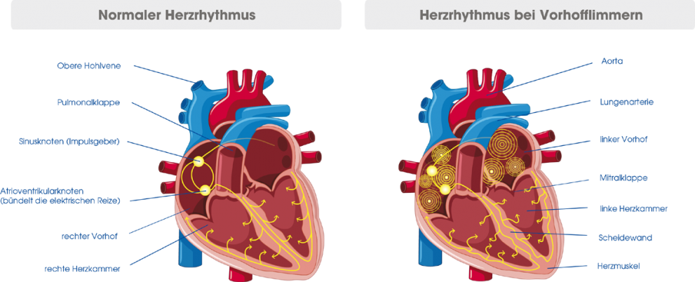 Herzrhythmus bei Vorhoffflimmern